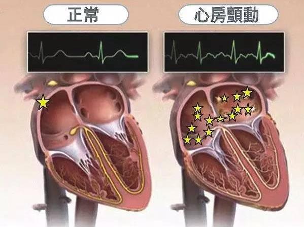 心房扑动与房颤