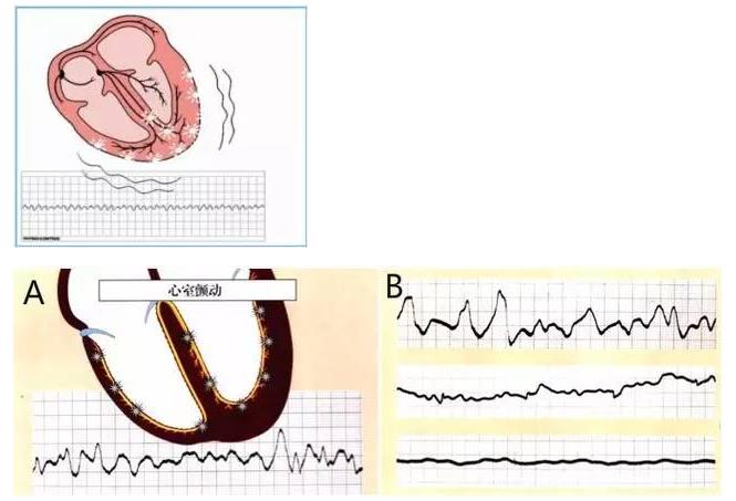 室性心动过速与心室颤动