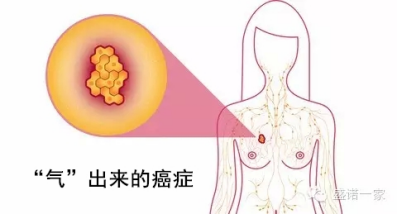 爱生气的女性易患乳腺癌