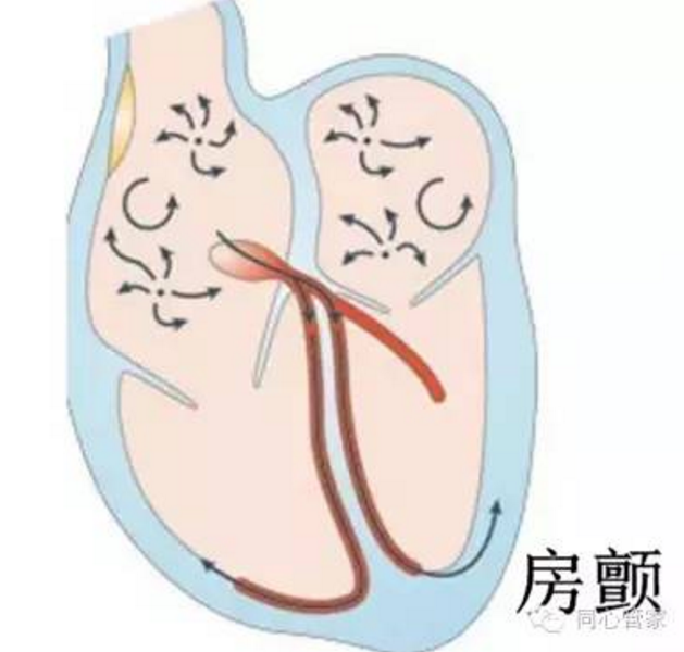 房颤的心跳收缩 房颤的心跳收缩